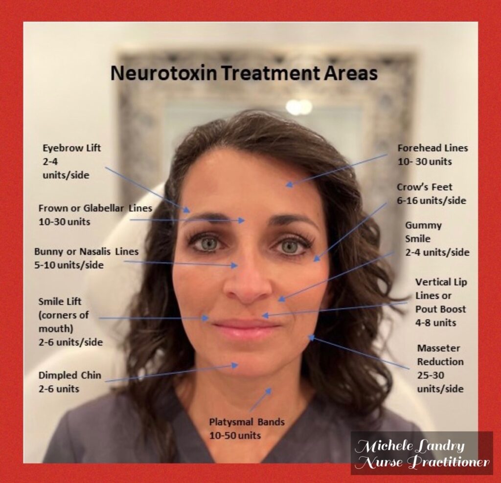 Neurotoxin Treatment Areas