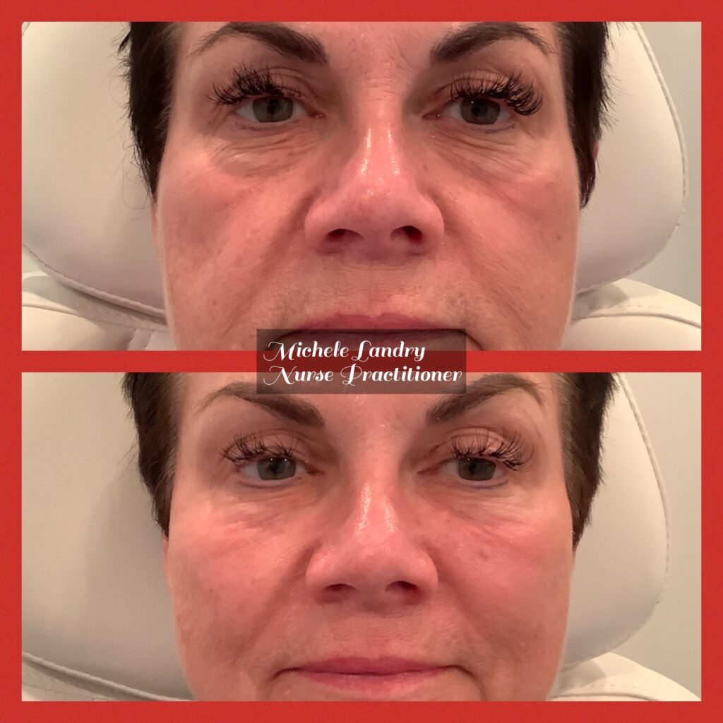 Patient D Neurotoxin Treatment, Dermal Filler Injections (cheek rejuvenation), Skin Care, and Microneedling